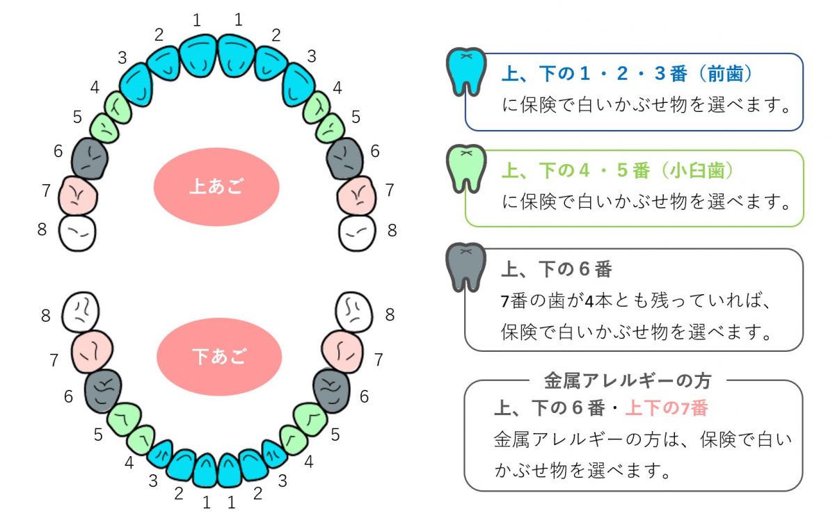 奥歯の銀歯を白くしたい！ 保険適用でできる白い歯 | ゆきこ歯科ブログ | 基山駅の歯医者,歯科ならゆきこ歯科